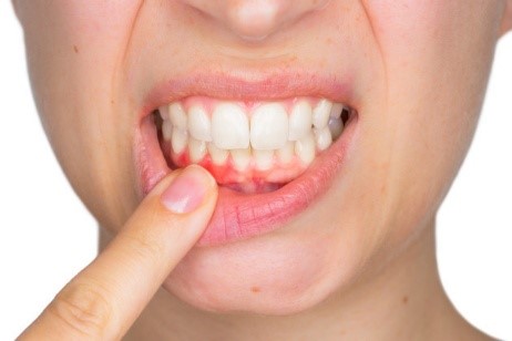 درمان عفونت دندان با دارچین