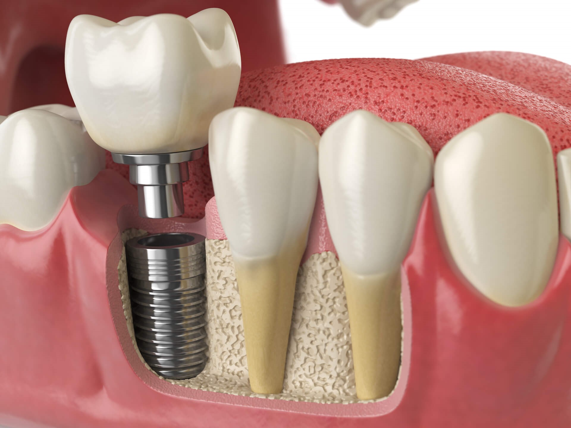 مقایسه بریج دندان و ایمپلنت