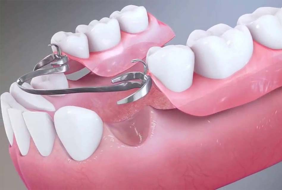 جایگزین‌های ایمپلنت دندان