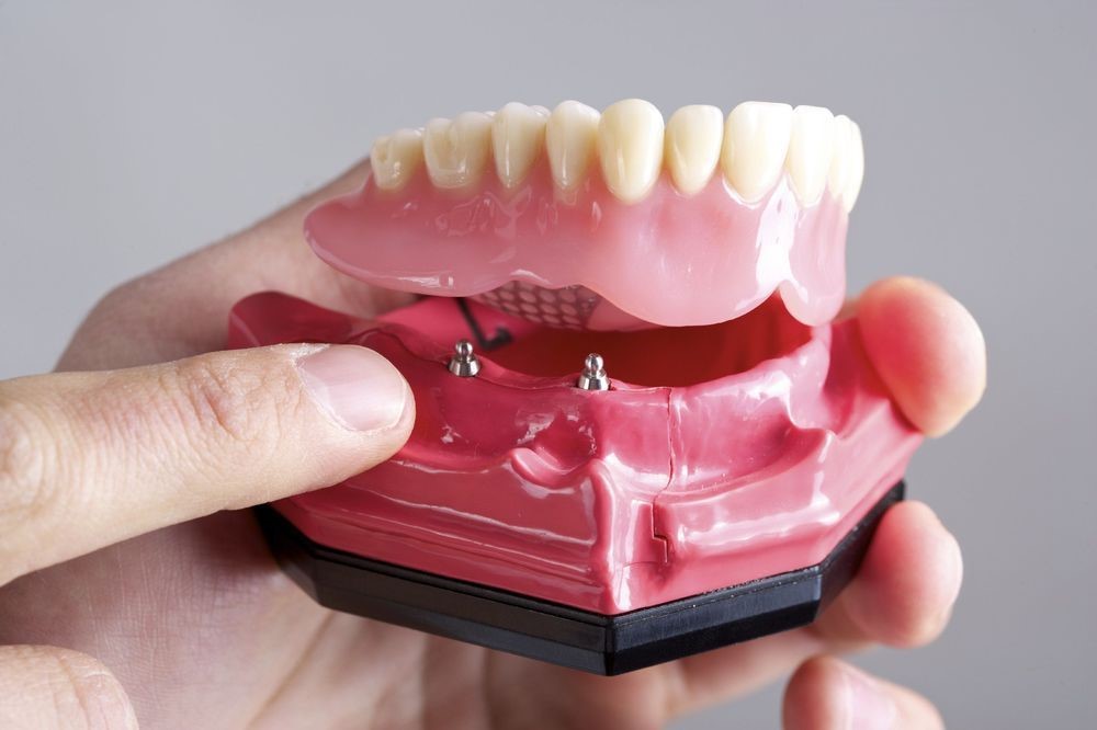 پروتز دندان متکی بر ایمپلنت