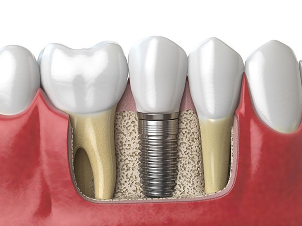  ایمپلنت های دندانی در کرج