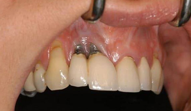 سیاه شدن لثه پس از ایمپلنت دندان
