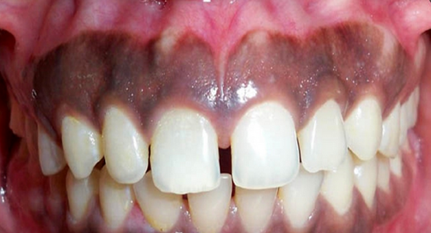 سیاه شدن لثه پس از ایمپلنت دندان