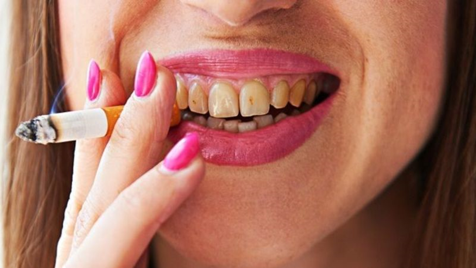 درمان سیاهی و تیرگی دندان
