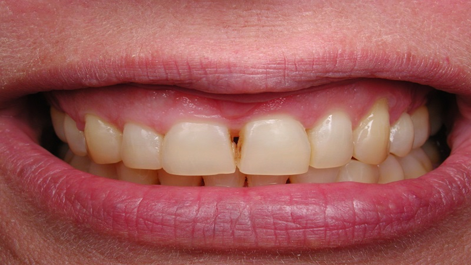 درمان سیاهی و تیرگی دندان