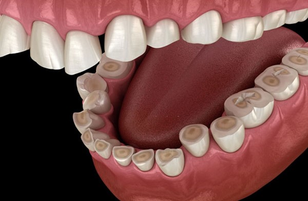 دندان قروچه