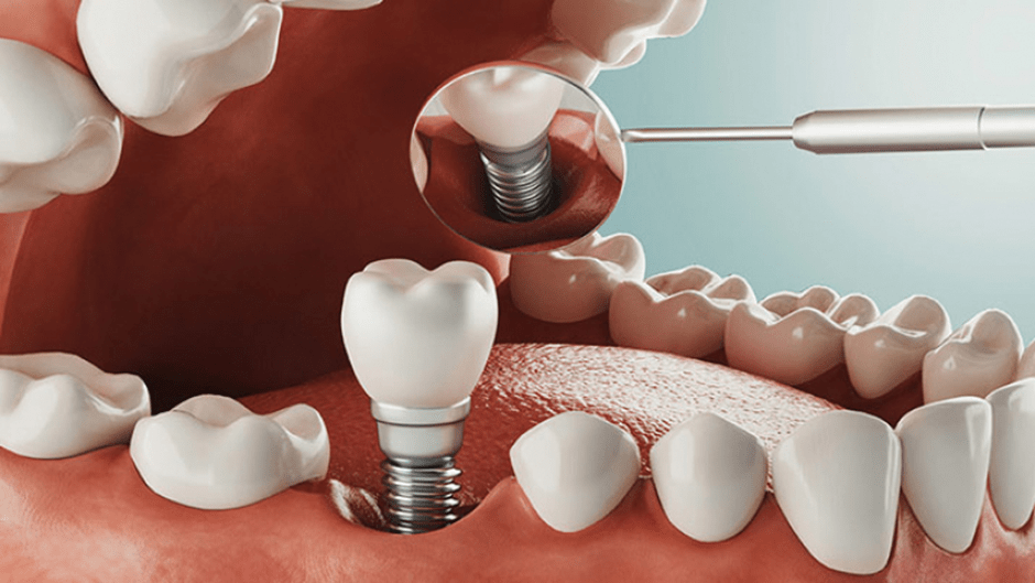 هزینه ایمپلنت دندان با بیمه تامین اجتماعی