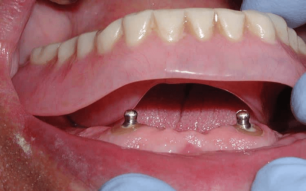 چه کسانی می‌توانند از پروتز دندانی استفاده کند؟