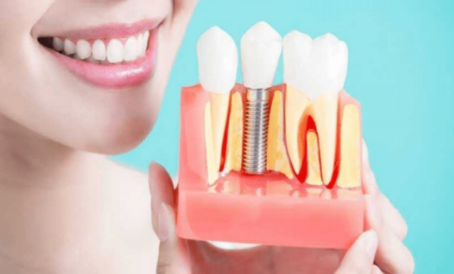 هزینه ایمپلنت دندان بدون بیمه تکمیلی 