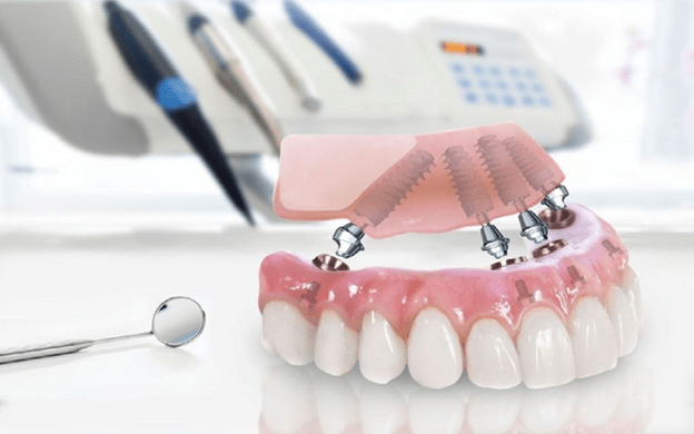 سخن پایانی در مورد تفاوت اوردنچر و دندان مصنوعی