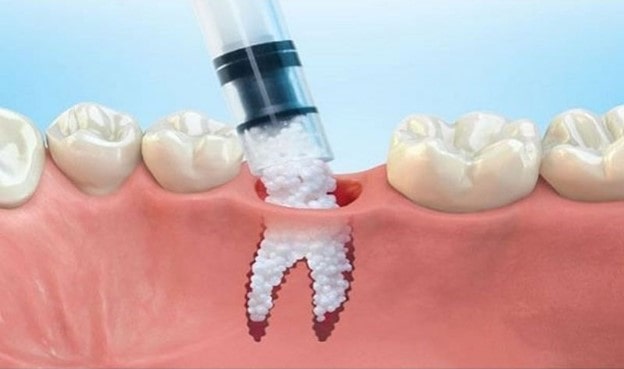 استفاده از پودر استخوان در ایمپلنت دندان