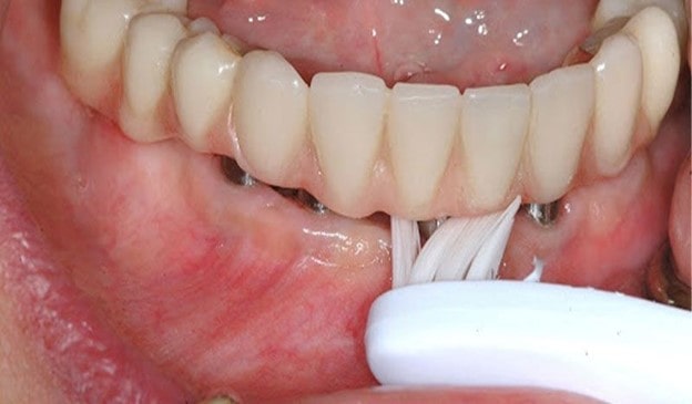 مزایای پیوند استخوان دندان برای ایمپلنت